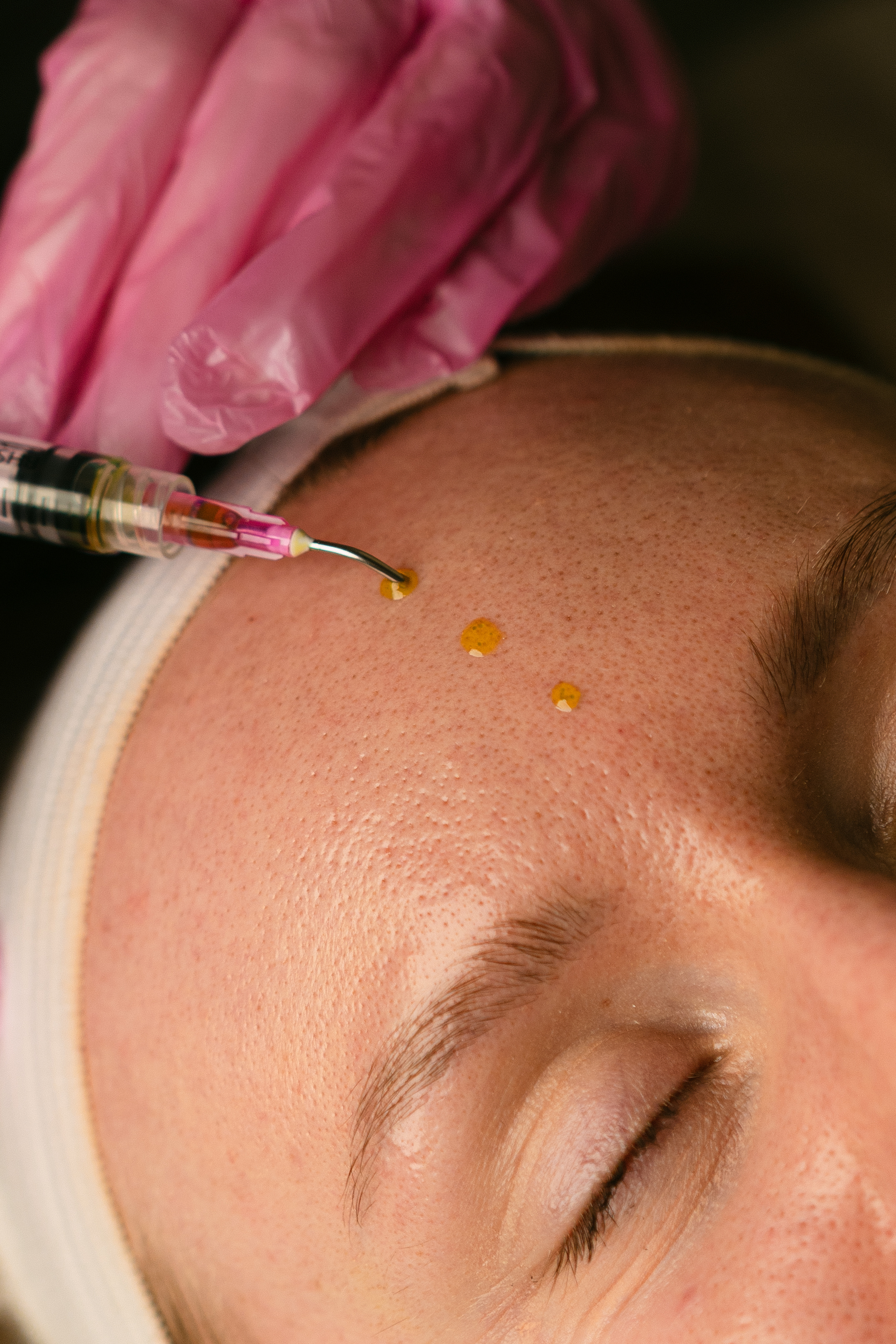 Microneedling + Salmon DNA